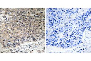 Peptide - +Immunohistochemistry analysis of paraffin-embedded human lung carcinoma tissue using DYNLL2 antibody.