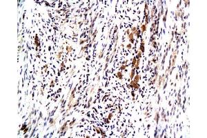 Formalin-fixed and paraffin embedded human colon carcinoma with Anti-Maspin Polyclonal Antibody, Unconjugated at 1:200, followed by conjugation to the secondary antibody and DAB staining (SERPINB5 anticorps  (AA 301-375))