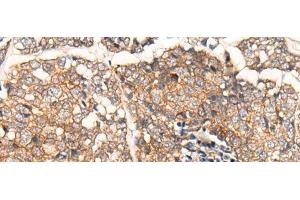 Immunohistochemistry of paraffin-embedded Human esophagus cancer tissue using CACNA2D2 Polyclonal Antibody at dilution of 1:45(x200)