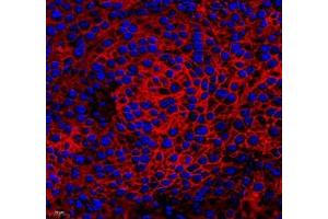 Immunofluorescence of paraffin embedded human melanoma using CA14 (ABIN7073665) at dilution of 1: 1000 (400x lens)