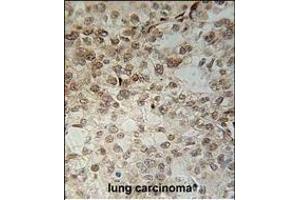 C14orf179 Antibody (Center) (ABIN651563 and ABIN2840304) immunohistochemistry analysis in formalin fixed and paraffin embedded human lung carcinoma followed by peroxidase conjugation of the secondary antibody and DAB staining. (IFT43 anticorps  (AA 145-171))