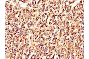 Immunohistochemistry of paraffin-embedded human melanoma using ABIN7158215 at dilution of 1:100