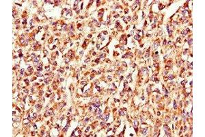 Immunohistochemistry of paraffin-embedded human melanoma using ABIN7158215 at dilution of 1:100 (LSMEM1 anticorps  (AA 1-131))