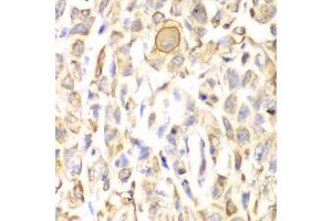 Immunohistochemistry of paraffin-embedded human lung cancer using CD151 antibody (ABIN3023660, ABIN3023661, ABIN3023662, ABIN1679069 and ABIN6219074) at dilution of 1:200 (40x lens). (CD151 anticorps  (AA 113-221))