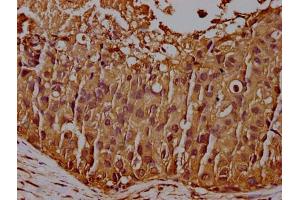 IHC image of ABIN7147160 diluted at 1:100 and staining in paraffin-embedded human breast cancer performed on a Leica BondTM system.