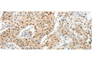 Immunohistochemistry of paraffin-embedded Human lung cancer tissue using UNC5CL Polyclonal Antibody at dilution of 1:50(x200) (UNC5CL anticorps)