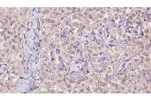 ABIN6273343 at 1/100 staining Human thyroid cancer tissue by IHC-P. (VDAC3 anticorps  (N-Term))