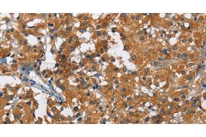 Immunohistochemistry of paraffin-embedded Human thyroid cancer using KLF7 Polyclonal Antibody at dilution of 1:60 (KLF7 anticorps)