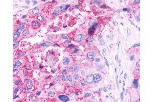 Anti-GPR61 antibody IHC of human Pancreas, Carcinoma. (GPR61 anticorps  (C-Term))
