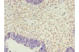 Immunohistochemistry of paraffin-embedded human ovarian cancer using ABIN7163399 at dilution of 1:100 (PRTFDC1 anticorps  (AA 2-225))
