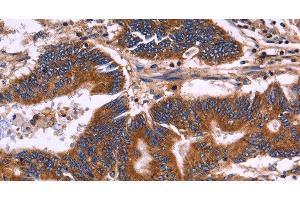 Immunohistochemistry of paraffin-embedded Human colon cancer tissue using KIR2DL1/3/4/S4 Polyclonal Antibody at dilution 1:30 (KIR2DL1/3/4/S4 anticorps)
