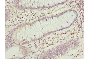 Immunohistochemistry of paraffin-embedded human colon cancer using ABIN7165174 at dilution of 1:100