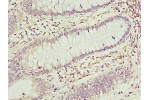 Immunohistochemistry of paraffin-embedded human colon cancer using ABIN7165174 at dilution of 1:100 (TNRC5 anticorps  (AA 31-278))
