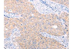 The image on the left is immunohistochemistry of paraffin-embedded Human cervical cancer tissue using ABIN7131482(TRIM32 Antibody) at dilution 1/40, on the right is treated with fusion protein. (TRIM32 anticorps)