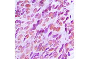 Immunohistochemical analysis of XRCC2 staining in human breast cancer formalin fixed paraffin embedded tissue section.