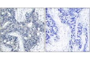 Immunohistochemistry analysis of paraffin-embedded human breast carcinoma, using PYK2 (Phospho-Tyr402) Antibody. (PTK2B anticorps  (pTyr402))