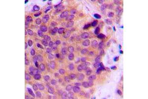 Immunohistochemical analysis of MMP2 staining in human breast cancer formalin fixed paraffin embedded tissue section.