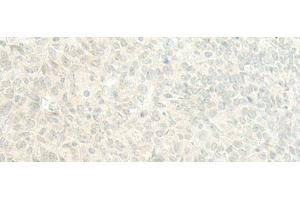 Immunohistochemistry of paraffin-embedded Human ovarian cancer tissue using ESRP2 Polyclonal Antibody at dilution of 1:95(x200) (ESRP2 anticorps)