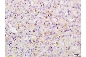 Formalin-fixed and paraffin embedded human brain glioma tissue labeled with Anti-Phospho-Wee1(Ser642) Polyclonal Antibody, Unconjugated  at 1:200 followed by conjugation to the secondary antibody and DAB staining (WEE1 anticorps  (pSer642))