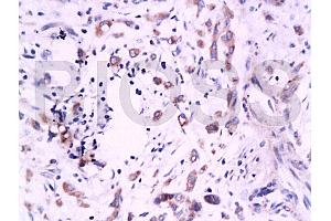 Formalin-fixed and paraffin embedded human colon carcinoma labeled Anti-B7H4 Polyclonal Antibody, Unconjugated (ABIN671736) at 1:200, followed by conjugation to the secondary antibody and DAB staining