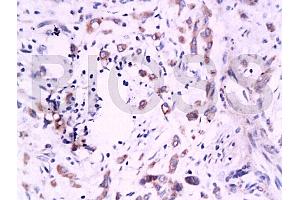 Formalin-fixed and paraffin embedded human colon carcinoma labeled Anti-B7H4 Polyclonal Antibody, Unconjugated (ABIN671736) at 1:200, followed by conjugation to the secondary antibody and DAB staining (VTCN1 anticorps  (AA 50-100))