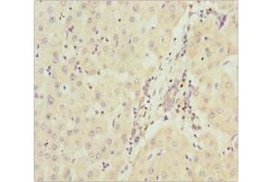 Immunohistochemistry of paraffin-embedded human liver cancer using ABIN7160913 at dilution of 1:100