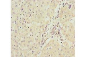 Immunohistochemistry of paraffin-embedded human liver cancer using ABIN7160913 at dilution of 1:100 (NDUFA9 anticorps  (AA 1-270))