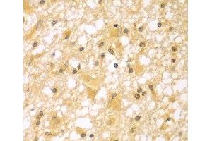 Immunohistochemistry of paraffin-embedded Human brain cancer using PAK6 Polyclonal Antibody at dilution of 1:100 (40x lens). (PAK6 anticorps)