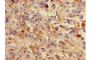 Immunohistochemistry of paraffin-embedded human melanoma using ABIN7157786 at dilution of 1:100 (DCT anticorps  (AA 44-205))