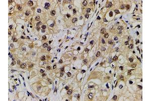 ABIN6277691 at 1/200 staining human renal clear cell carcinoma tissue sections by IHC-P. (Ephrin B2 anticorps  (C-Term))