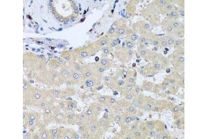 Immunohistochemistry of paraffin-embedded Human liver damage using COTL1 Polyclonal Antibody at dilution of 1:100 (40x lens).