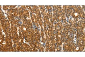 Immunohistochemistry of paraffin-embedded Human thyroid cancer using PTCH1 Polyclonal Antibody at dilution of 1:50
