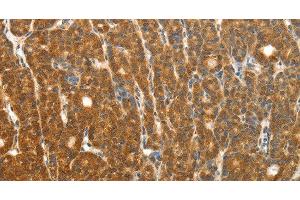 Immunohistochemistry of paraffin-embedded Human thyroid cancer using PTCH1 Polyclonal Antibody at dilution of 1:50 (Patched 1 anticorps)