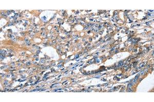 Immunohistochemistry of paraffin-embedded Human gastric cancer using AKR1D1 Polyclonal Antibody at dilution of 1:35 (AKR1D1 anticorps)