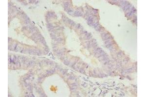 Immunohistochemistry of paraffin-embedded human endometrial cancer using ABIN7157970 at dilution of 1: 100 (LEFTY2 anticorps  (AA 57-366))