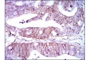 Immunohistochemical analysis of paraffin-embedded rectum cancer tissues using LPA mouse mAb with DAB staining. (Lp(a) anticorps  (AA 1823-2013))