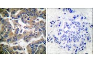 Immunohistochemistry analysis of paraffin-embedded human breast carcinoma, using GR (Phospho-Ser211) Antibody. (GR (AA 181-230), (pSer211) anticorps)
