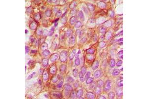 Immunohistochemical analysis of BAX staining in human breast cancer formalin fixed paraffin embedded tissue section.