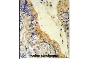 Formalin-fixed and paraffin-embedded human colon carcinoma reacted with ACADM Antibody (Center), which was peroxidase-conjugated to the secondary antibody, followed by DAB staining. (Medium-Chain Specific Acyl-CoA Dehydrogenase, Mitochondrial (MCAD) (AA 189-217) anticorps)