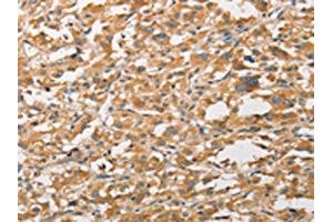 The image on the left is immunohistochemistry of paraffin-embedded Human thyroid cancer tissue using ABIN7131608(WNT11 Antibody) at dilution 1/20, on the right is treated with fusion protein.