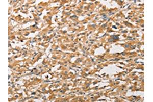 The image on the left is immunohistochemistry of paraffin-embedded Human thyroid cancer tissue using ABIN7131608(WNT11 Antibody) at dilution 1/20, on the right is treated with fusion protein. (WNT11 anticorps)