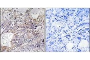 Immunohistochemistry analysis of paraffin-embedded human breast carcinoma tissue, using BAD (Ab-155) Antibody. (BAD anticorps  (AA 119-168))
