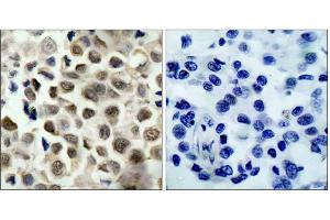 Immunohistochemical analysis of paraffin-embedded human lung carcinoma tissue, using HDAC8 (phospho-Ser39) antibody (E011128). (HDAC8 anticorps  (pSer39))