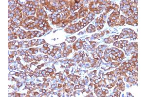 Formalin-fixed, paraffin-embedded human Melanoma stained with Moesin Mouse Monoclonal Antibody (MSN/492). (Moesin anticorps)