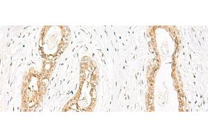 Immunohistochemistry of paraffin-embedded Human breast cancer tissue using JPT1 Polyclonal Antibody at dilution of 1:35(x200) (JPT1 anticorps)