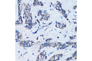 Immunohistochemistry of paraffin-embedded human breast cancer using HDAC5 antibody (ABIN6290464) at dilution of 1:100 (40x lens). (HDAC5 anticorps)