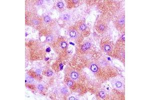 Immunohistochemical analysis of GNA11 staining in human liver cancer formalin fixed paraffin embedded tissue section.
