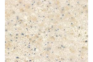 ABIN6257844 and ABIN6274385 at 1/100 staining human astrocytoma by IHC-P. (DOK7 anticorps  (C-Term))