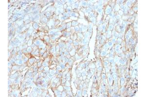 Formalin-fixed, paraffin-embedded human Cervical Carcinoma stained with PD-L1-Monospecific Mouse Monoclonal Antibody (PDL1/2746).