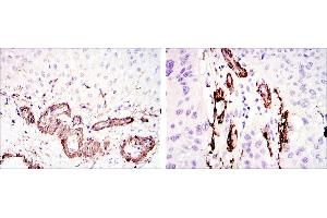 Immunohistochemical analysis of paraffin-embedded liver tissues (left) and lung cancer tissues (right) using ACTA2 mouse mAb with DAB staining.